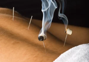 acupuncture et moxibustion manosque
